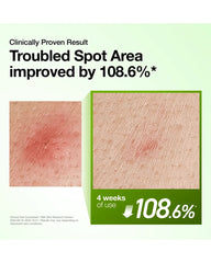 Anua Azelaic Acid Serum clinical result showing improvement in troubled spot appearance after four weeks