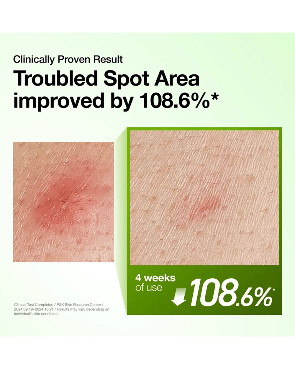 Anua Azelaic Acid Serum clinical result showing improvement in troubled spot appearance after four weeks