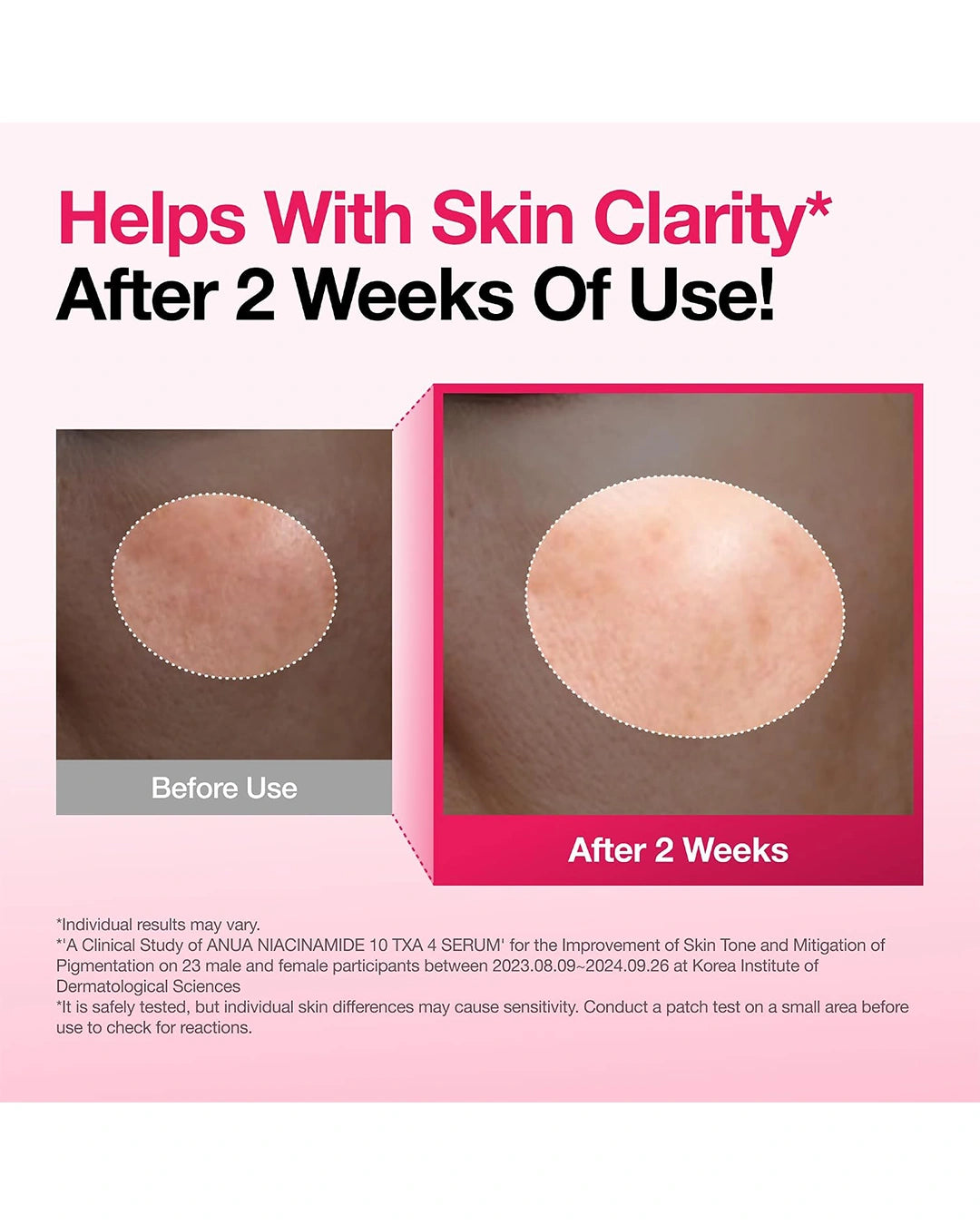 Anua Niacinamide 10+ TXA 4 Serum before and after skin clarity results image
