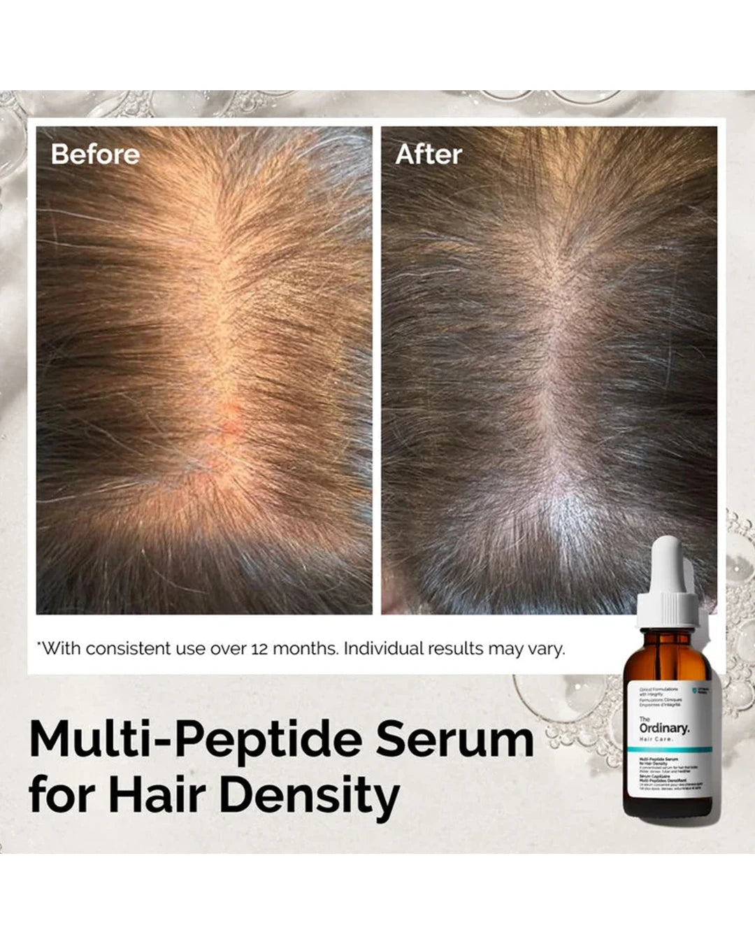The Ordinary Multi-Peptide Serum for Hair Density before and after example with consistent use over 12 months